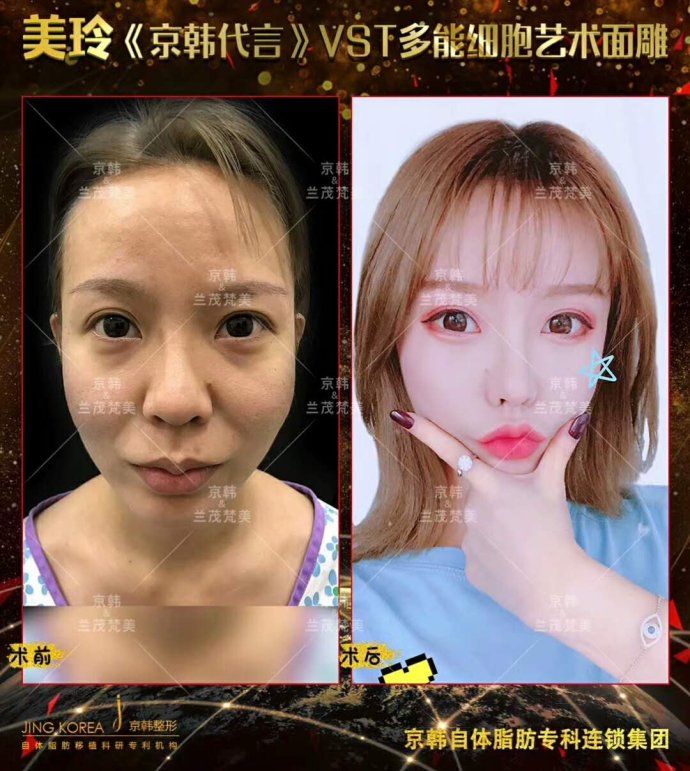 喬愛軍面部精雕案例
