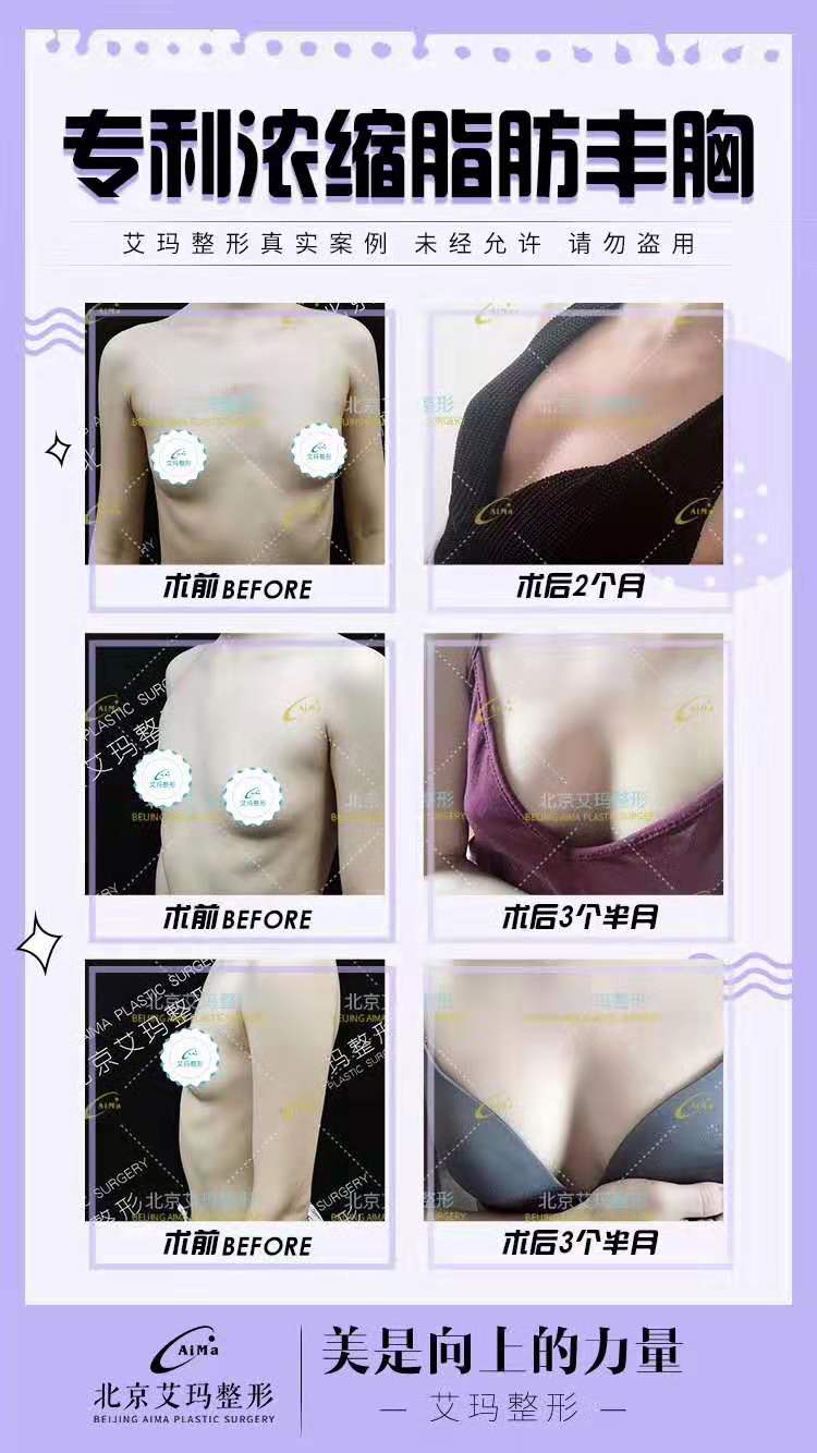 韋元強(qiáng)脂肪豐胸