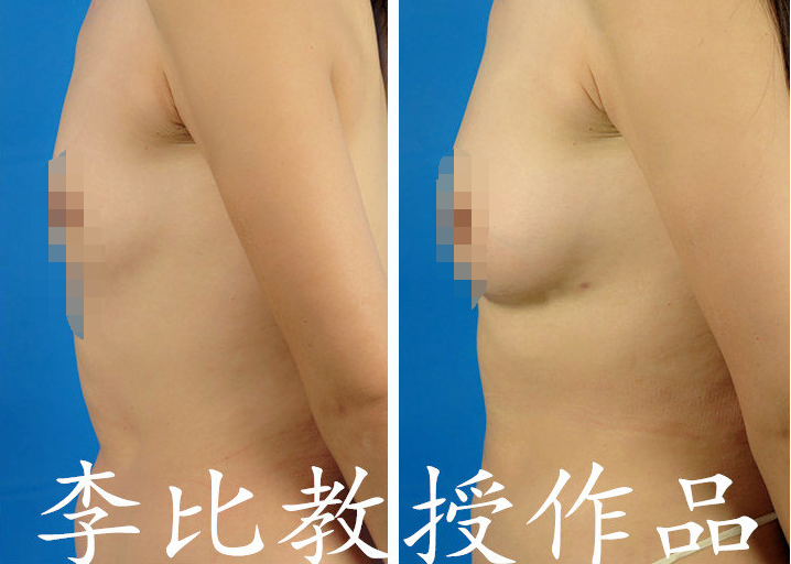 李比自體脂肪豐胸案例