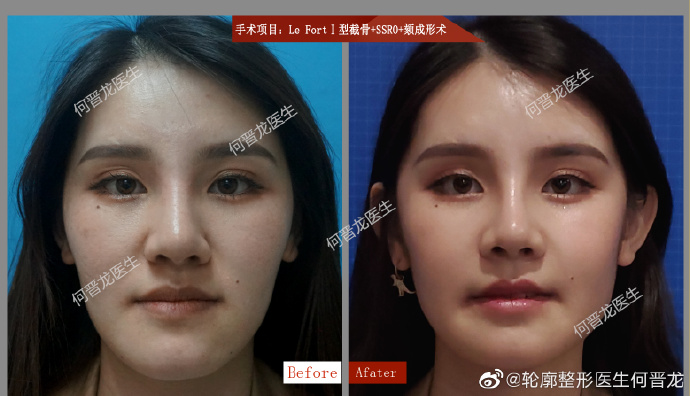 何晉龍改臉型案例