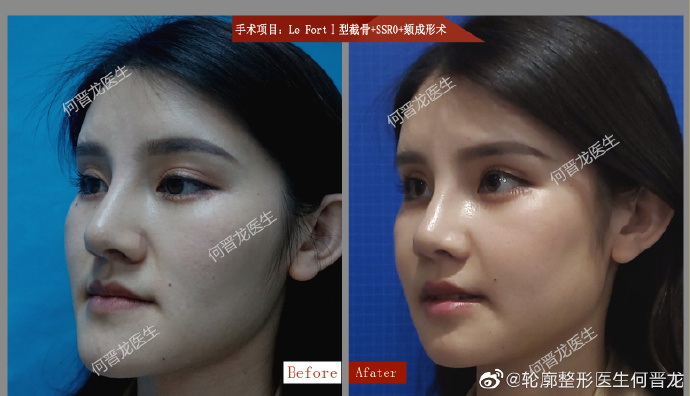 何晉龍改臉型案例