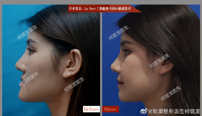 何晉龍改臉型案例
