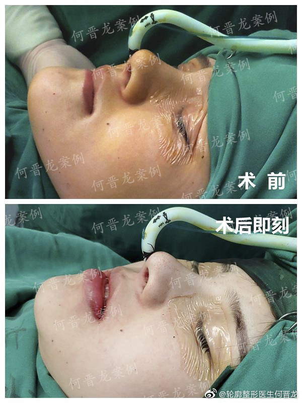 何晉龍改臉型案例