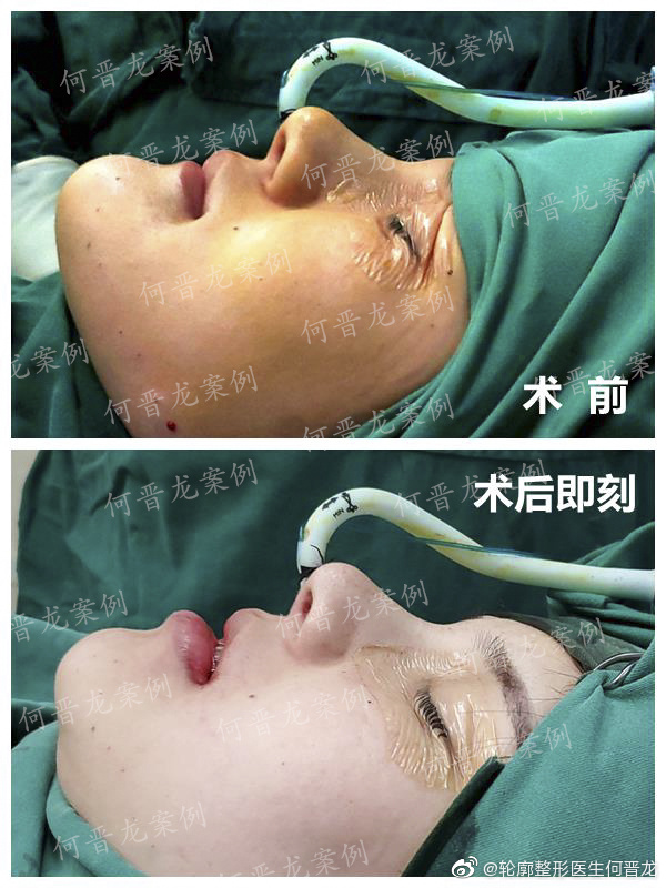 何晉龍改臉型案例