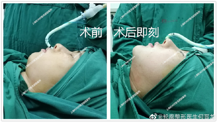 何晉龍改臉型案例