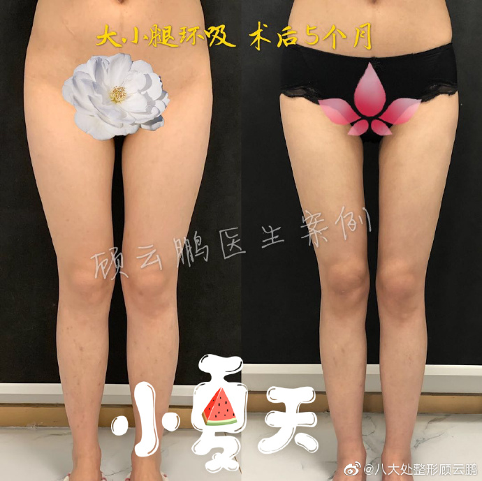 顧云鵬大小腿吸脂案例