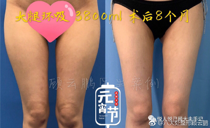 顧云鵬大腿吸脂案例