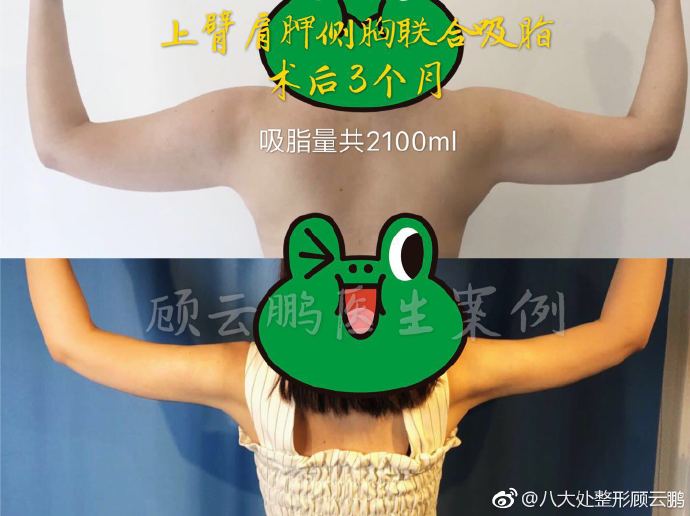 顧云鵬吸脂案例