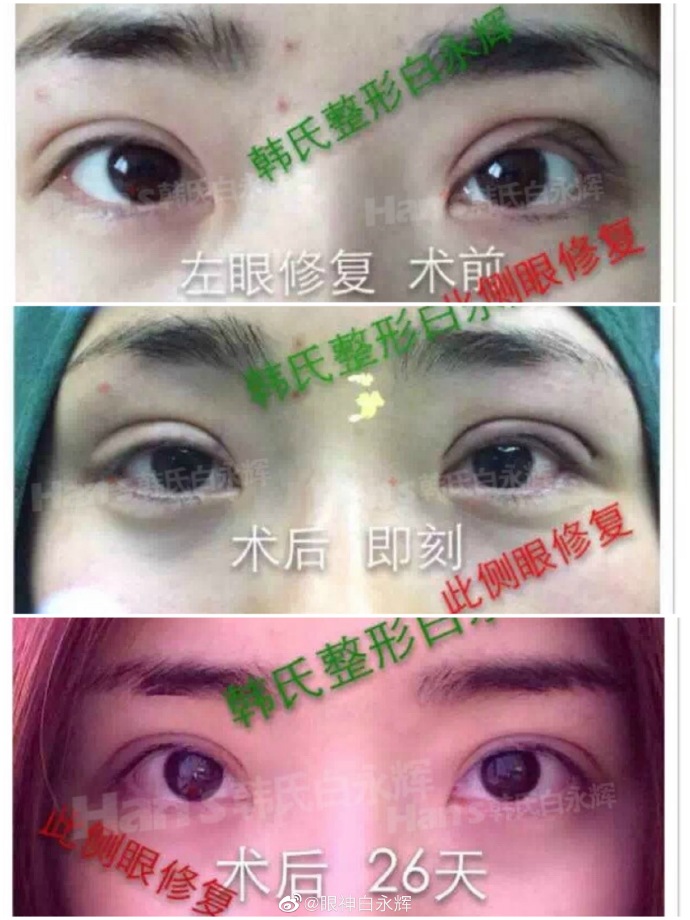 白永輝雙眼皮修復案例