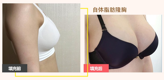 孫瑞霞脂肪豐胸案例
