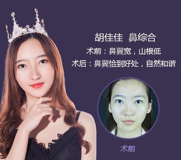 沈紹勇隆鼻案例