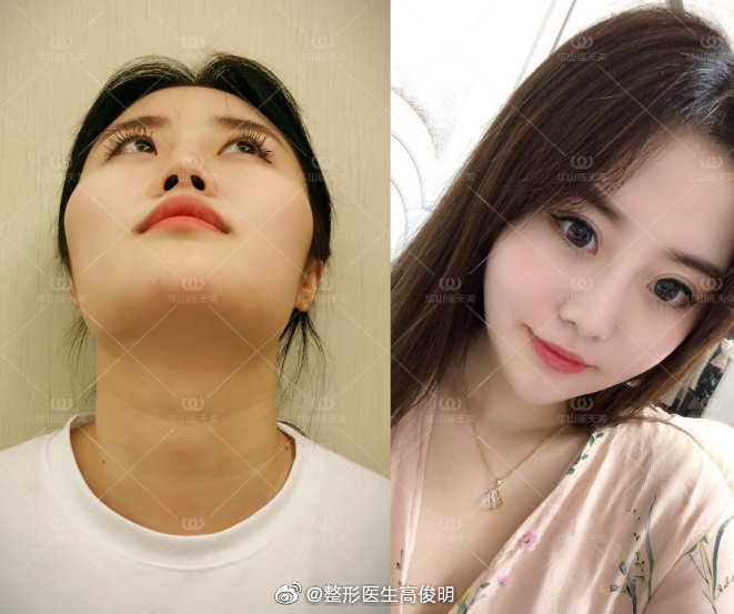 高俊明改臉型案例