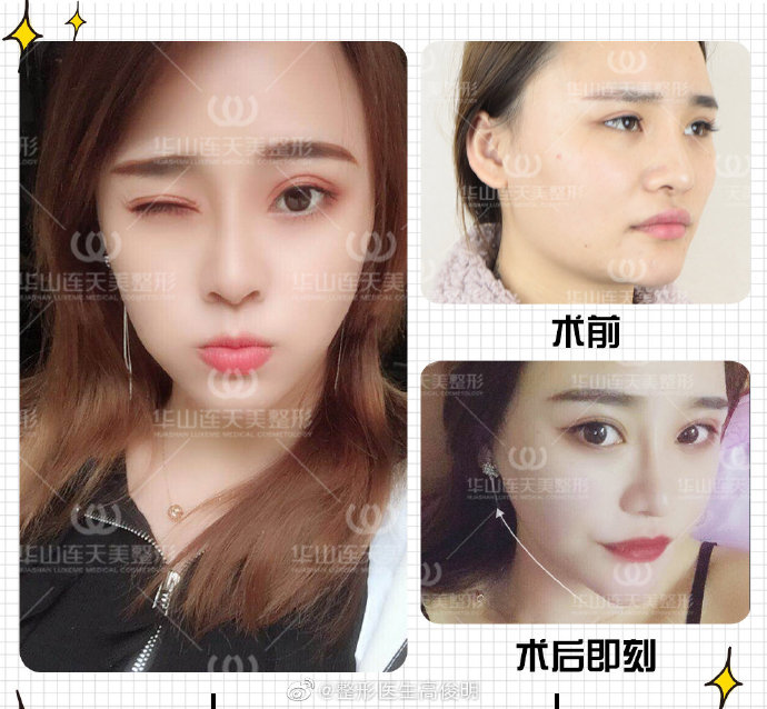 高俊明改臉型案例