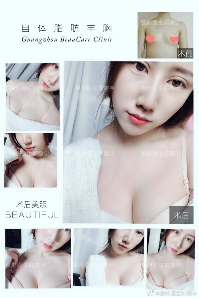 郭震宇脂肪豐胸案例