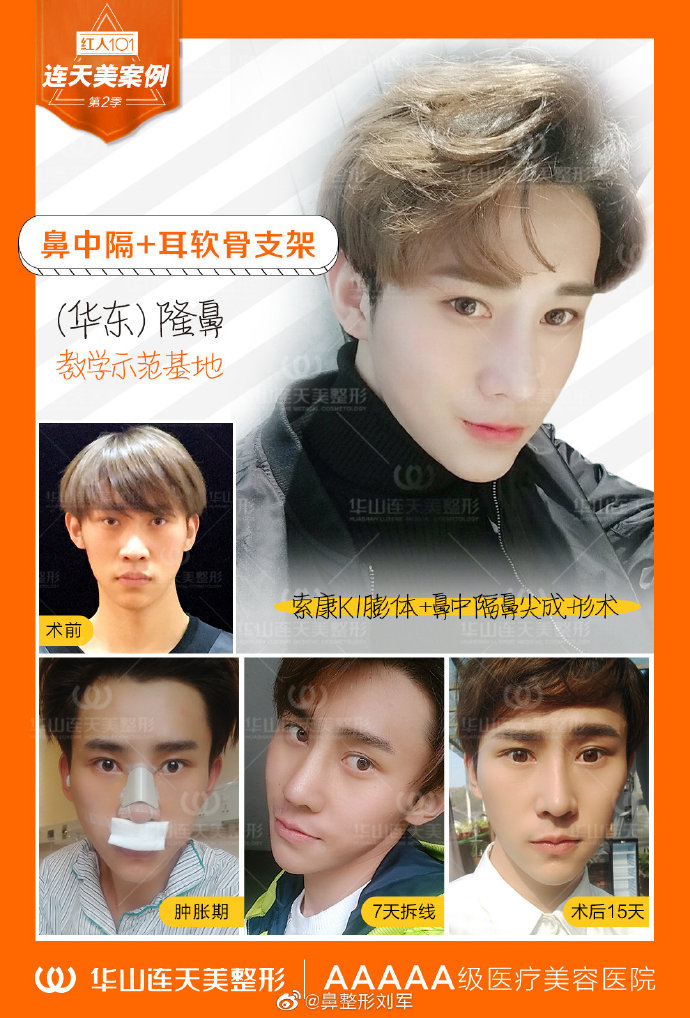 杭州連天美劉軍隆鼻案例