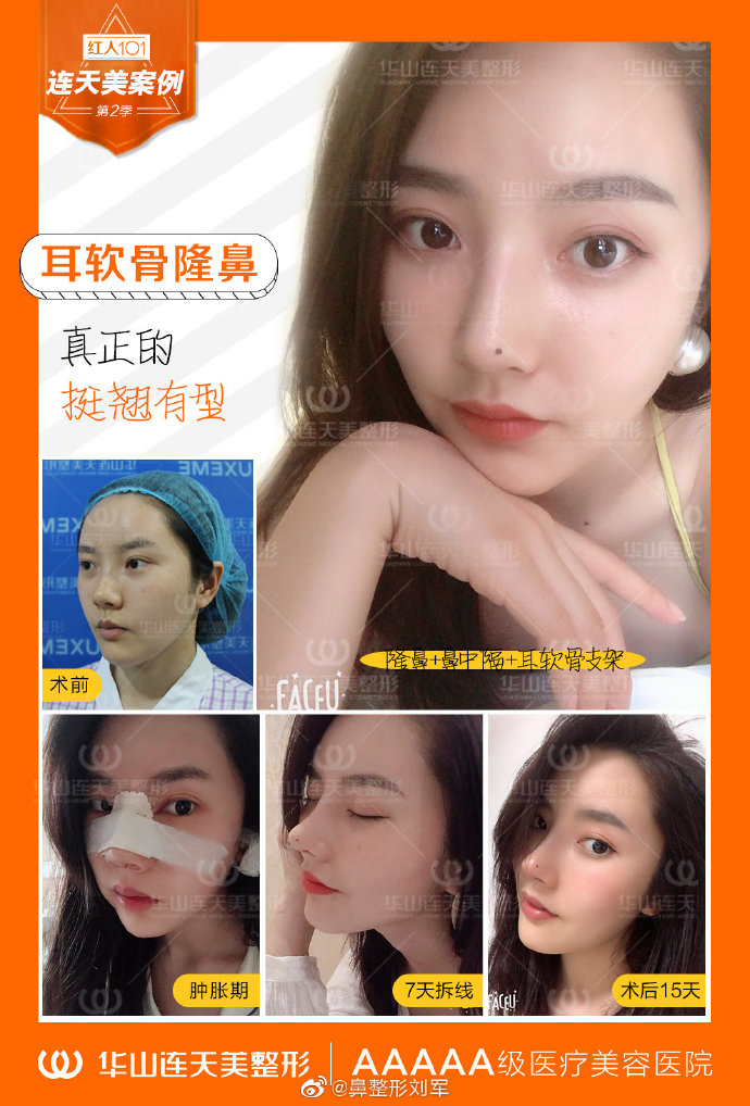 杭州連天美劉軍隆鼻案例
