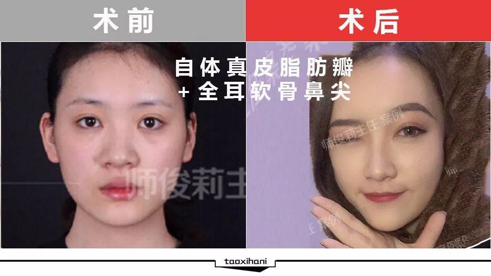 師俊莉鼻綜合案例
