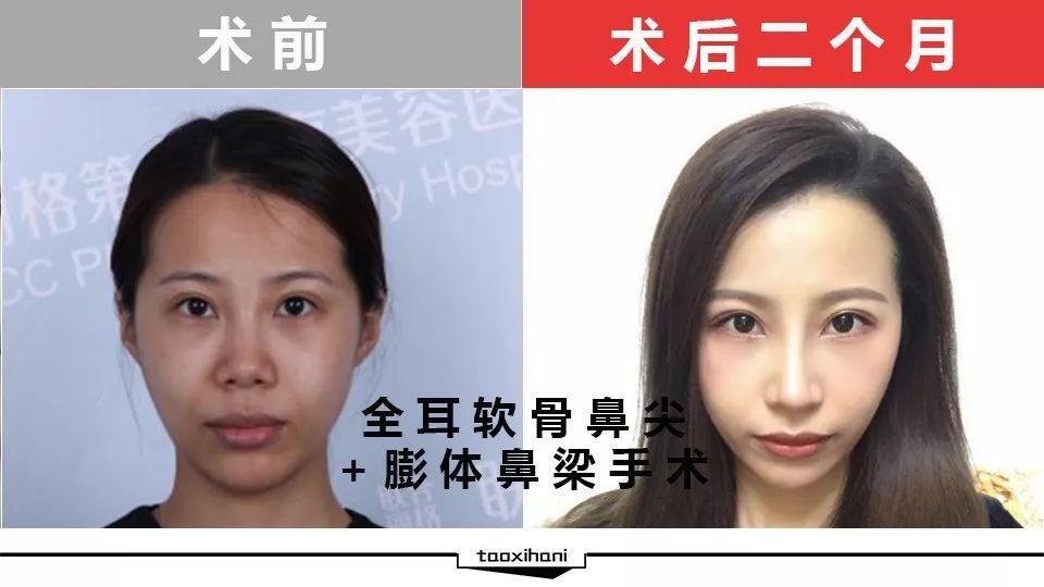 師俊莉鼻綜合案例