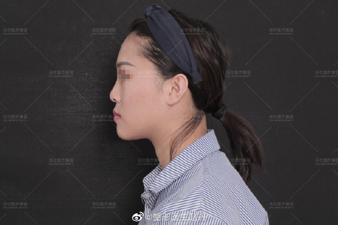 趙丹隆鼻案例