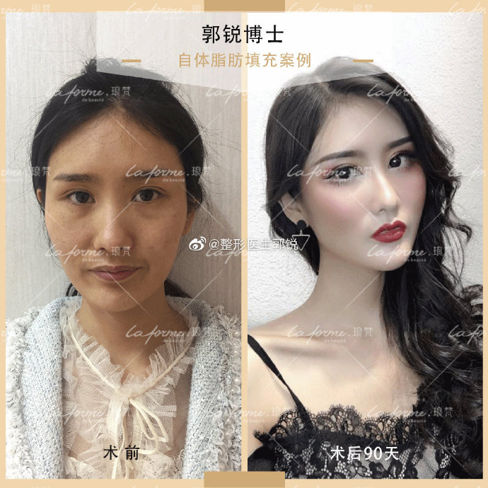 郭銳面部填充