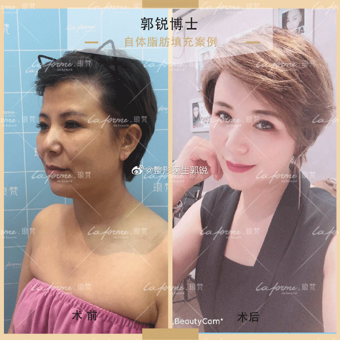 郭銳線雕面部提升