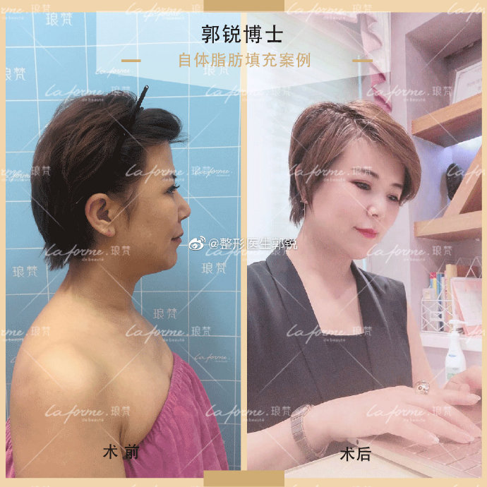 郭銳線雕面部提升