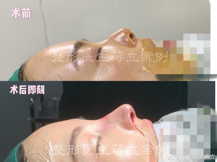 蔣立醫生鼻綜合案例