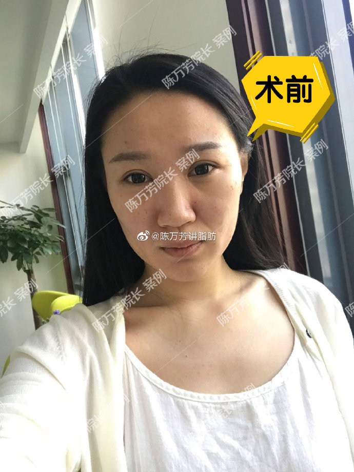 陳萬(wàn)芳面部吸脂案例