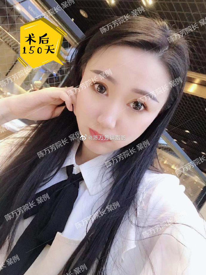 陳萬(wàn)芳面部吸脂案例
