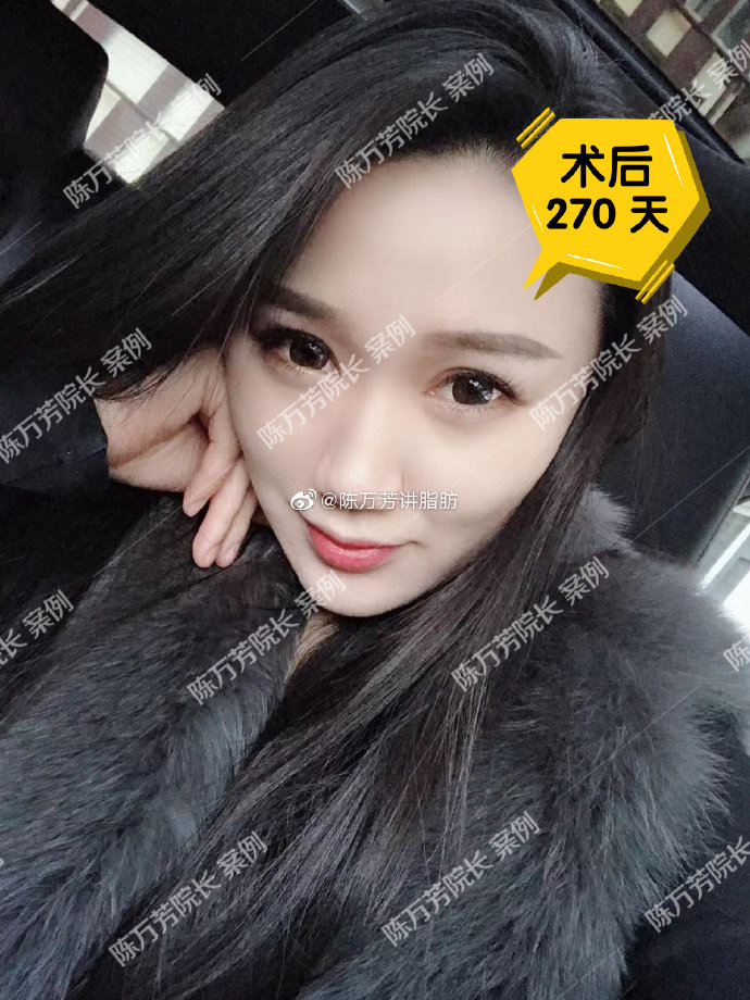 陳萬(wàn)芳吸脂案例