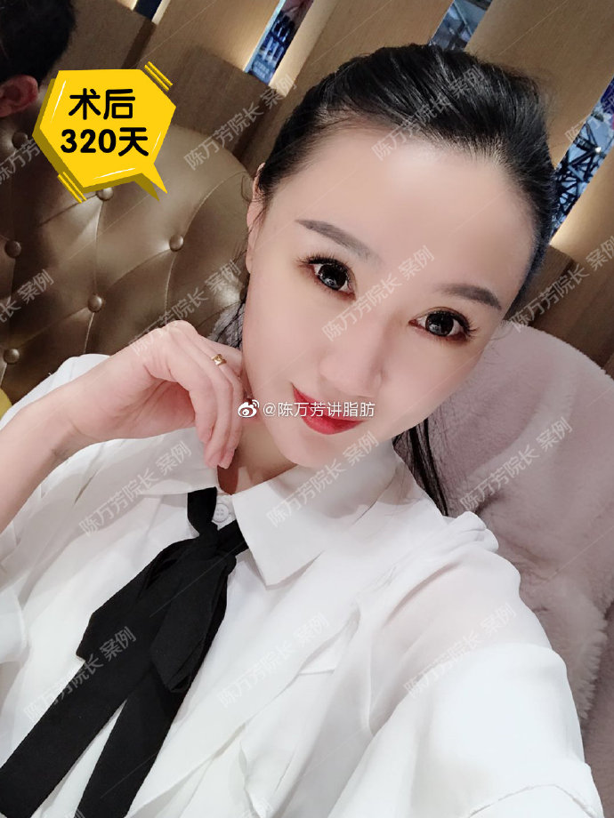 陳萬(wàn)芳吸脂案例