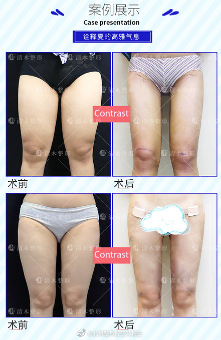 馬梅生大腿吸脂案例