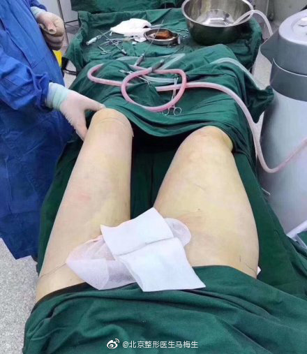 馬梅生大腿吸脂案例