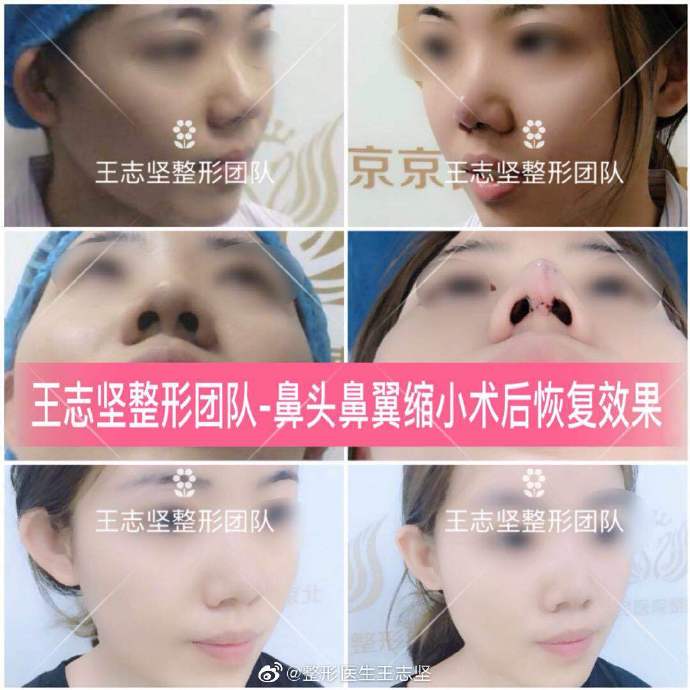 王志堅(jiān)鼻頭鼻翼縮小案例