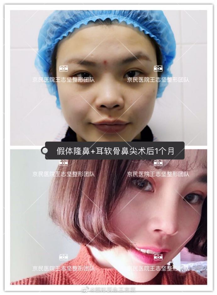 王志堅(jiān)假體隆鼻案例