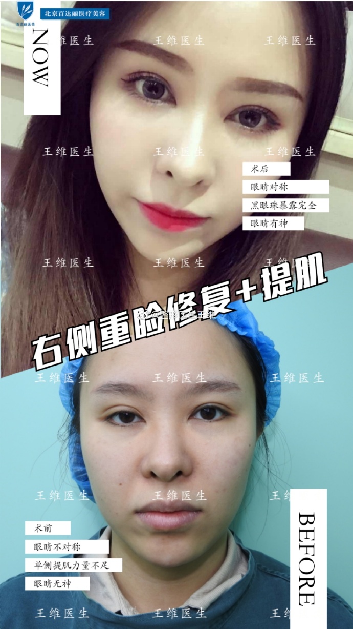 王維雙眼皮修復案例