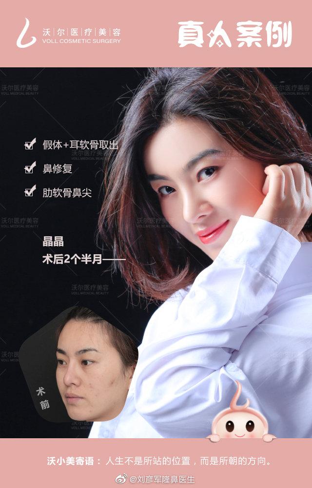 北京和上海隆鼻專家都有哪些？李占強PK劉彥軍哪個做隆鼻最好？