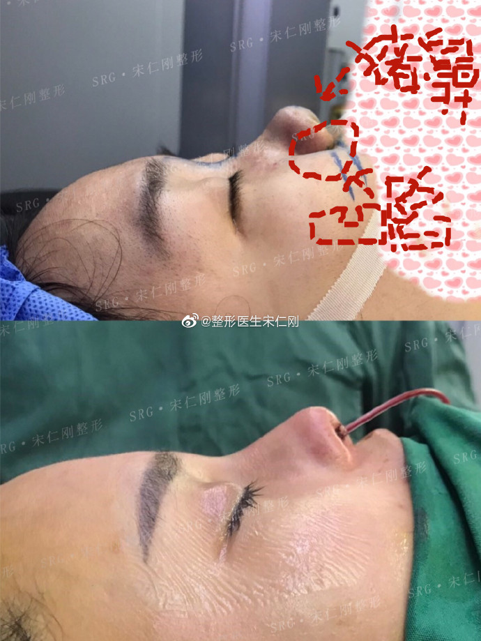 宋仁剛鼻子矯正案例