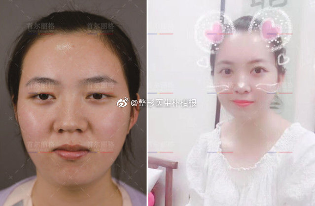 樸相根雙眼皮案例