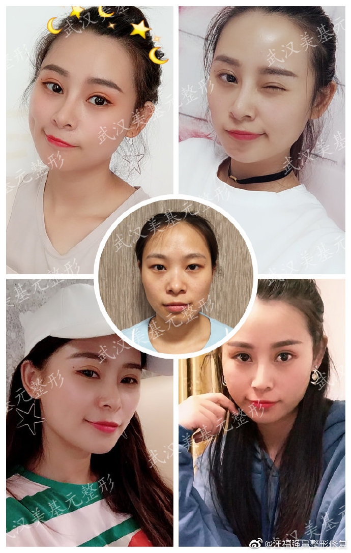 汪福強(qiáng)鼻修復(fù)案例
