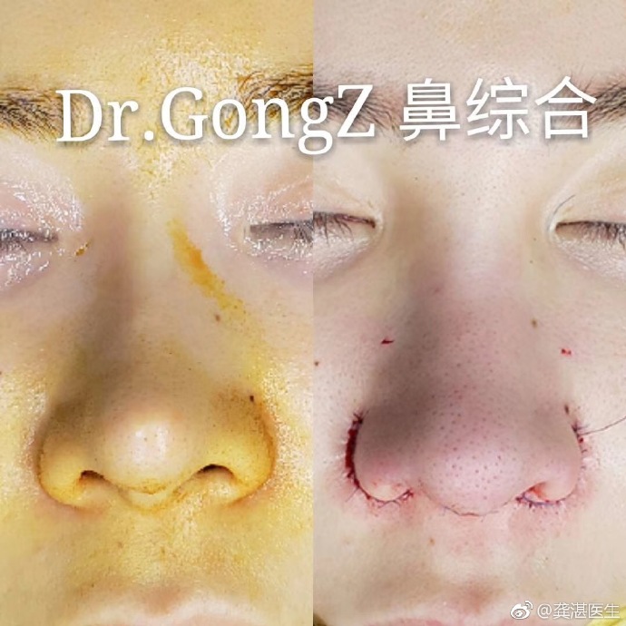 龔湛鼻修復案例