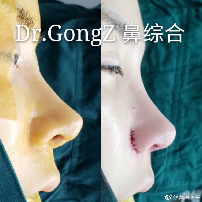 龔湛鼻修復案例