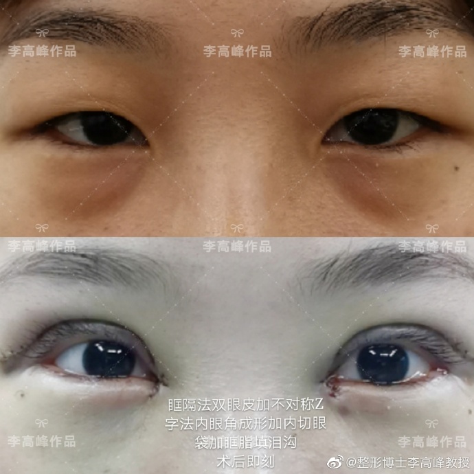 李高峰雙眼皮案例