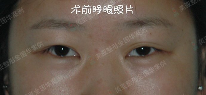 金國(guó)華雙眼皮修復(fù)案例