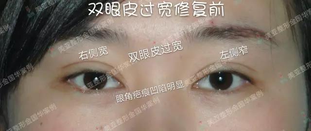 金國(guó)華雙眼皮修復(fù)案例