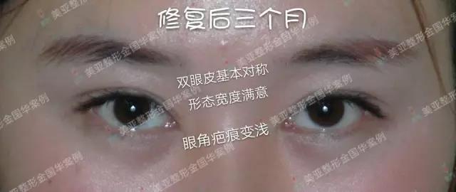 金國(guó)華雙眼皮修復(fù)案例