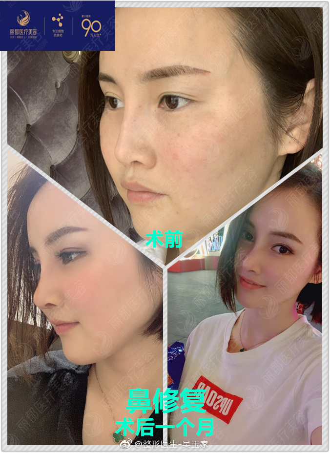 吳玉家鼻修復案例