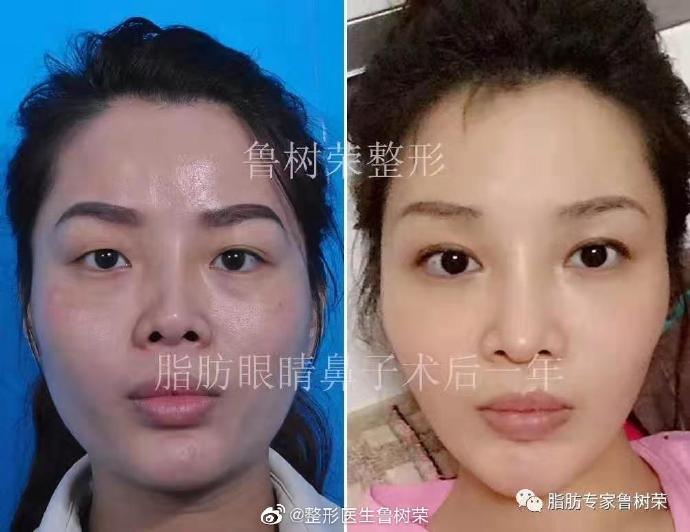 魯樹榮面部填充案例