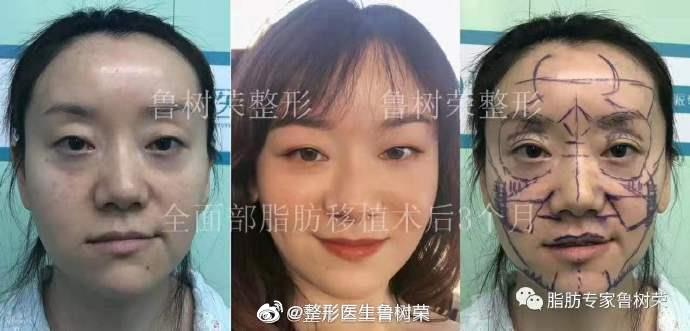 魯樹榮面部填充案例