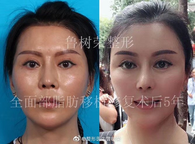 魯樹榮面部填充案例